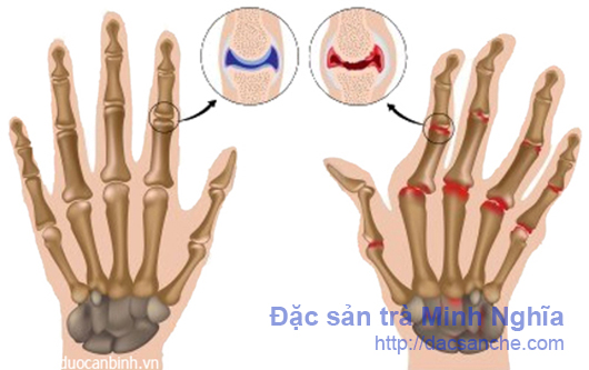 Tổn thương khớp trong bệnh lý thấp khớp