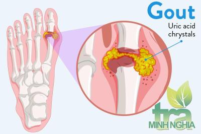 Mách bạn 6 cách để đào thải acid uric ra ngoài cơ thể